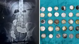 Indian Man Consumes 39 Coins, 37 Magnets In Belief Of Zinc's Bodybuilding Benefits - Health And Wellness
