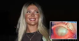 Woman blinded by parasites after making mistake with her contact lenses