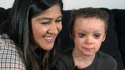 Boy with rare skin condition sleeps with eyes closed for the first time