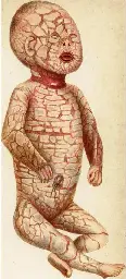 Harlequin-type ichthyosis - Wikipedia