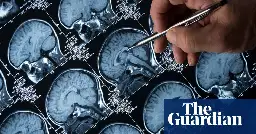 Poor physical health associated with depression through link to brain, research shows