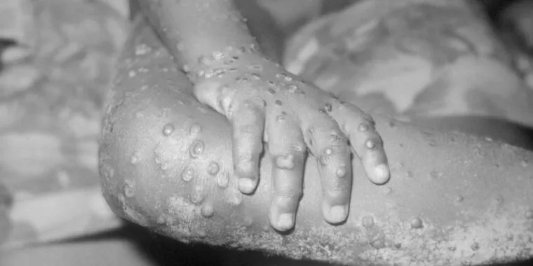 New mpox outbreak raises alarm; WHO considers declaring international emergency