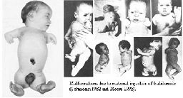 Thalidomide scandal - Wikipedia