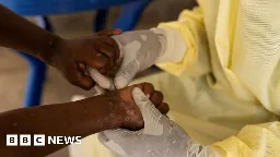 First case of more dangerous mpox found outside Africa