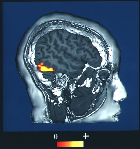 Prosopagnosia - Wikipedia