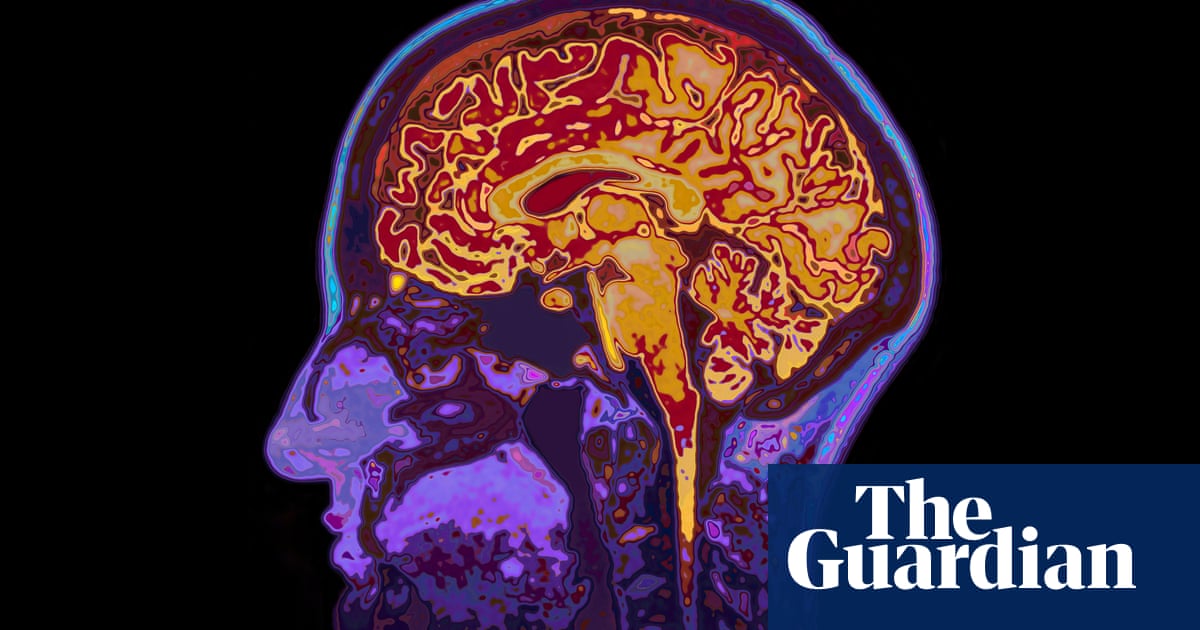 Experts urge health regulators to approve ‘turning point’ dementia drugs