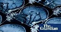 Ten-minute brain scan could detect dementia early, study suggests