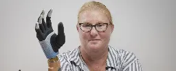 Revolutionary Bionic Hand Fuses With Woman's Bones, Muscles, And Nerves