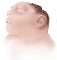 Anencephaly - Absence of a major portion of the brain, skull, and scalp that occurs during embryonic development