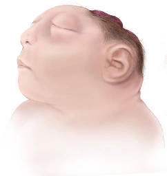 Anencephaly - Wikipedia