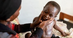 U.S. confirms first case of more aggressive strain of mpox