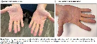 Man on carnivore diet develops yellowish nodules on his hands, feet and elbows