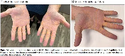 Man on carnivore diet develops yellowish nodules on his hands, feet and elbows