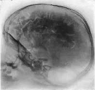 TIL before CT and MRI’s were available, doctors used to replace the fluid in and around the brain with air to do imaging with X-rays.