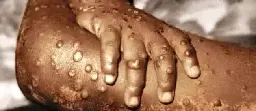 Profiteering lets Mpox epidemic spread out of control | Climate & Capitalism