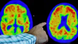 Donanemab found to slow Alzheimer's and hailed a 'turning point in fight against disease'