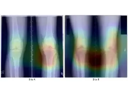 Do knee X-rays show if you drink beer? Medical AI versus algorithmic shortcutting