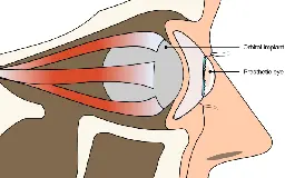 Automatic data-driven design and 3D printing of custom ocular prostheses - Nature Communications