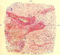 Encephalitis lethargica - sleeping sickness