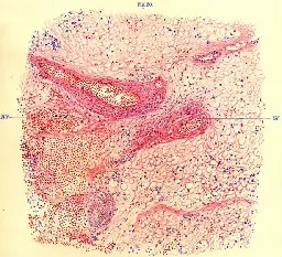 Encephalitis lethargica - Wikipedia