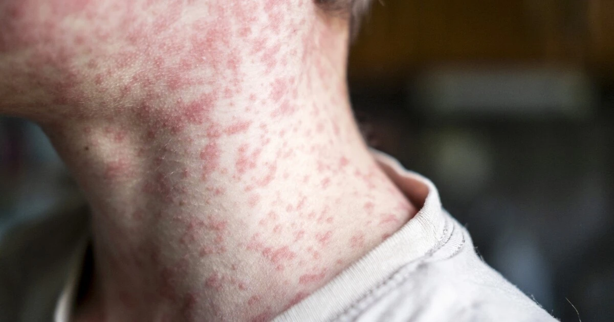 Measles warnings issued in San Antonio and San Marcos as Texas outbreak spreads