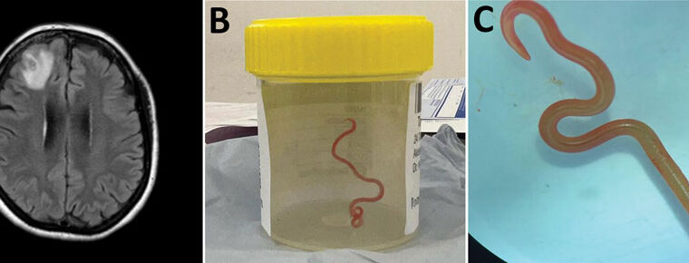 Woman’s mystery illness turns out to be 3-inch snake parasite in her brain