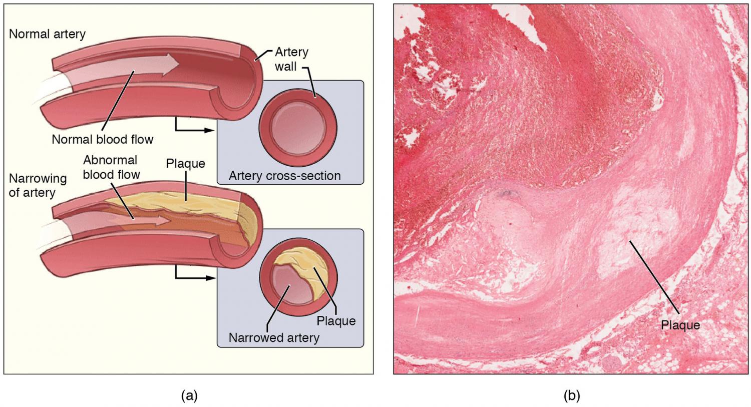 Metals in the body from pollutants associated with progression of harmful plaque buildup in the arteries